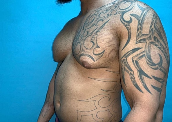 Gynecomastia Before & After