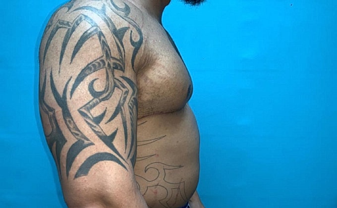 Gynecomastia Before & After