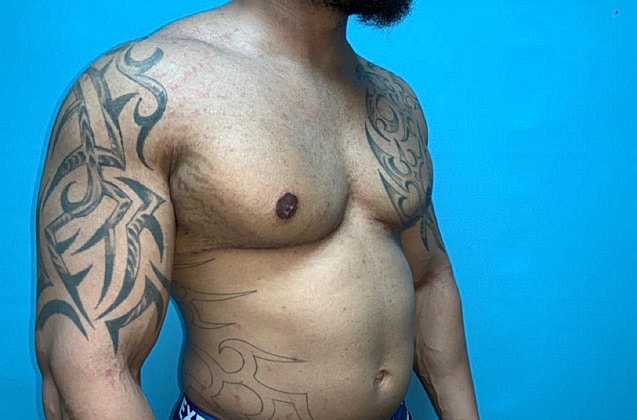 Gynecomastia Before & After