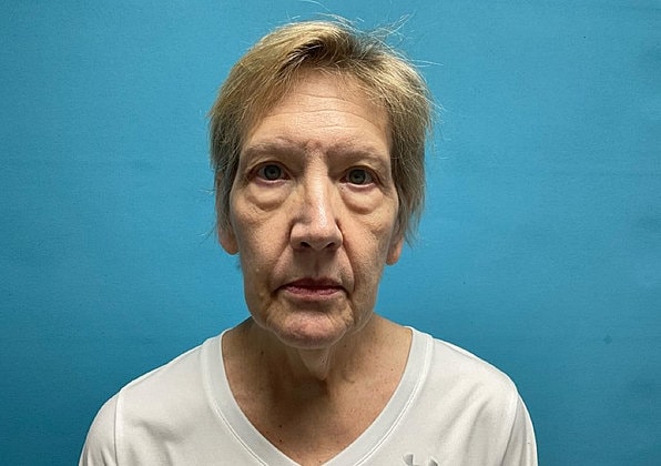 Facelift Before & After