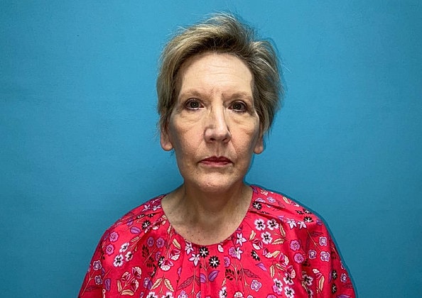 Facelift Before & After