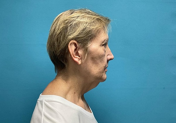 Facelift Before & After