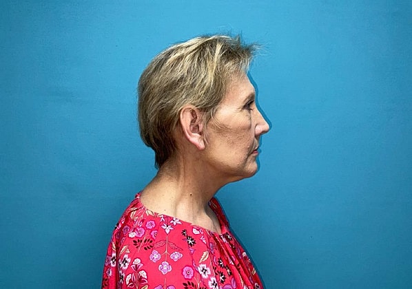 Facelift Before & After