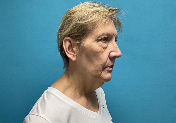 Facelift Before & After