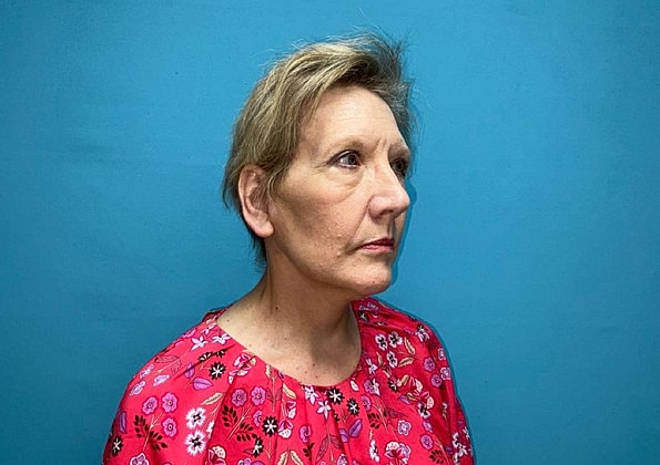 Facelift Before & After