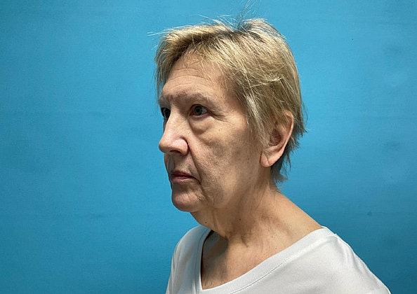 Facelift Before & After