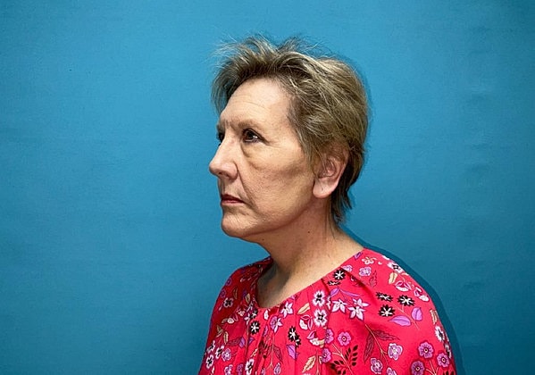 Facelift Before & After
