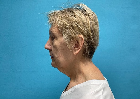Facelift Before & After