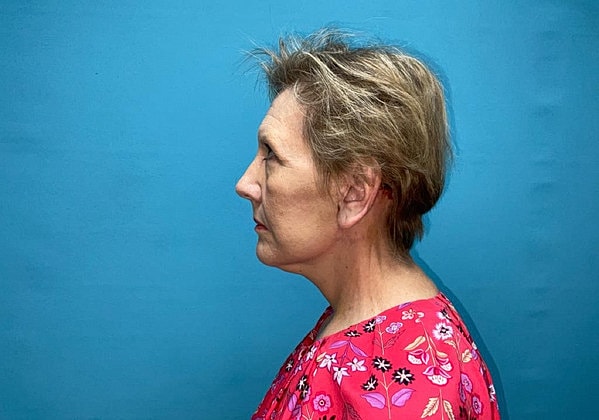 Facelift Before & After