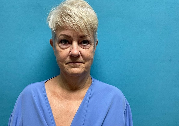 Facelift Before & After