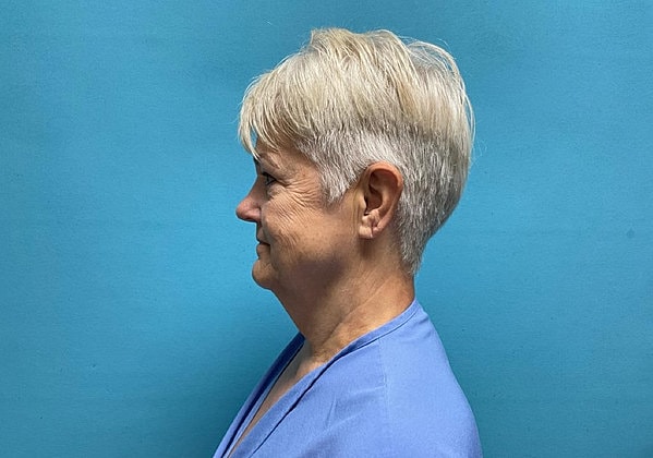 Facelift Before & After
