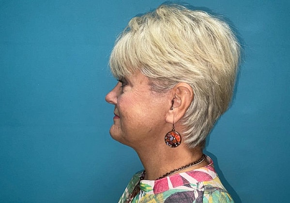 Facelift Before & After