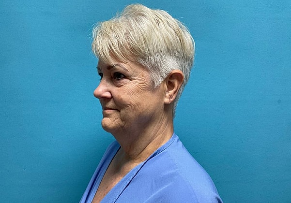 Facelift Before & After