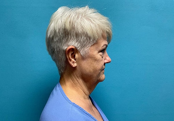 Facelift Before & After
