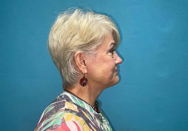 Facelift Before & After