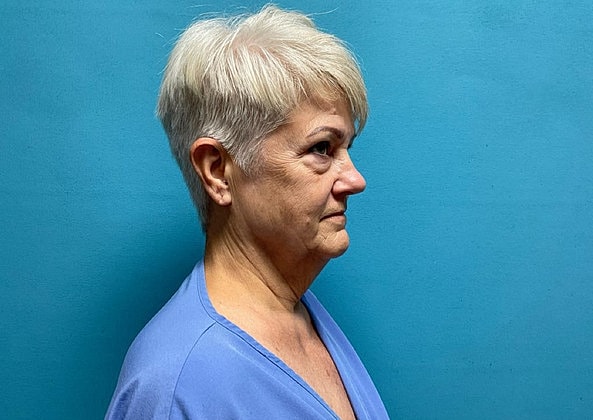 Facelift Before & After