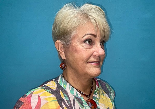 Facelift Before & After