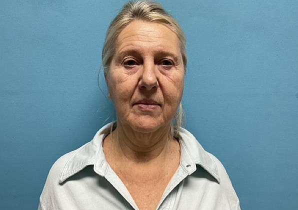 Facelift Before & After