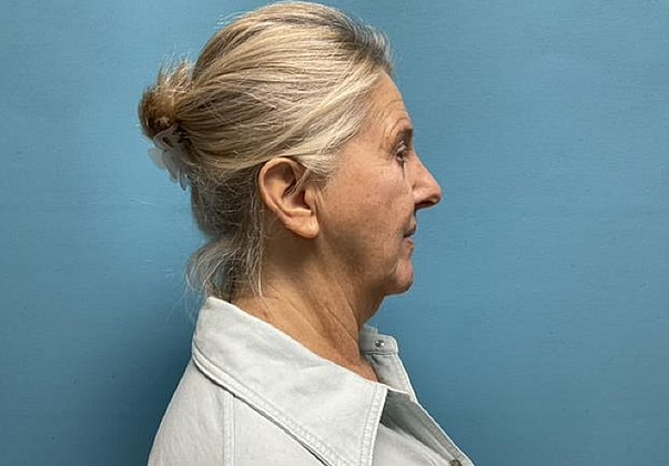Facelift Before & After