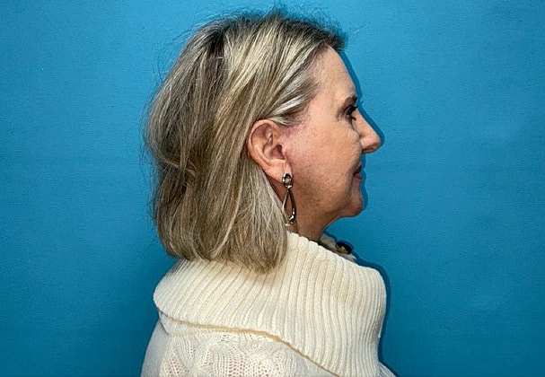 Facelift Before & After