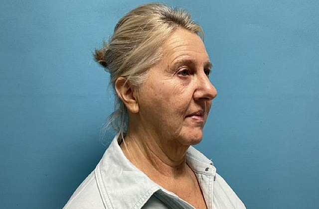 Facelift Before & After