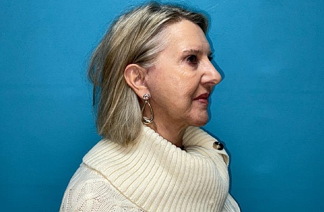 Facelift Before & After