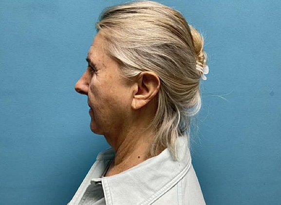Facelift Before & After