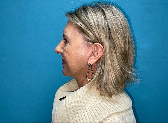 Facelift Before & After