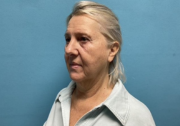 Facelift Before & After
