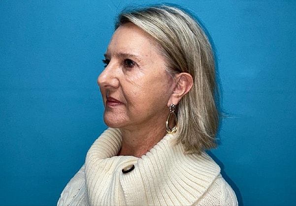 Facelift Before & After
