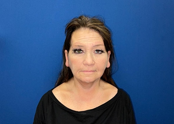 Facelift Before & After