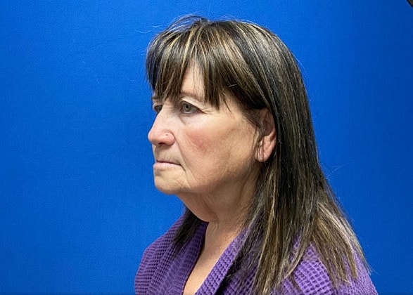 Facelift Before & After