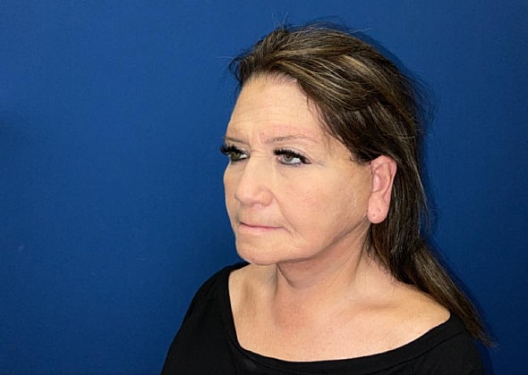 Facelift Before & After