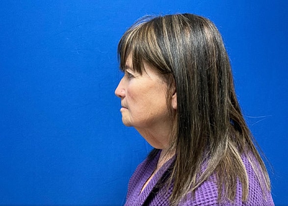 Facelift Before & After