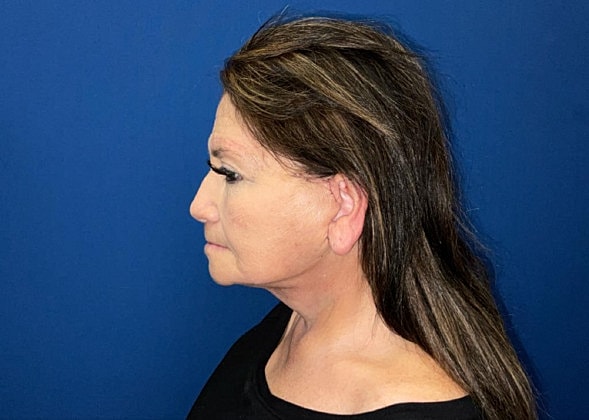 Facelift Before & After