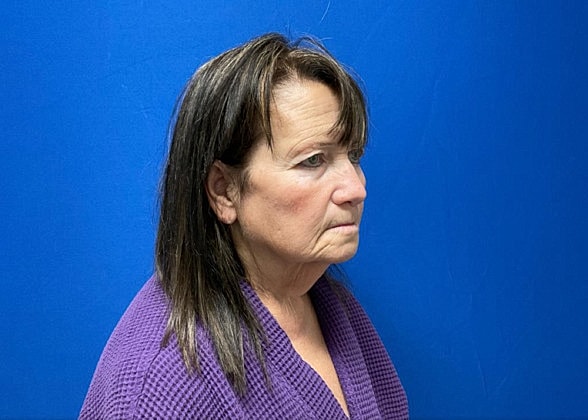 Facelift Before & After