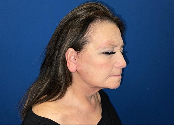 Facelift Before & After