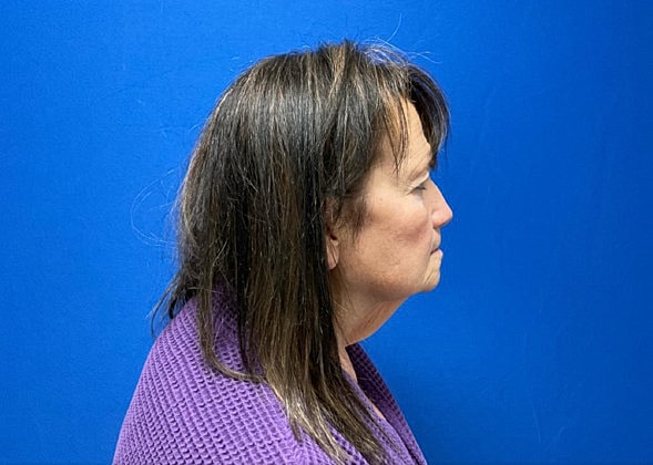 Facelift Before & After