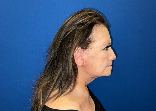 Facelift Before & After