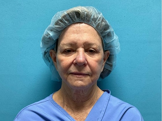 Facelift Before & After