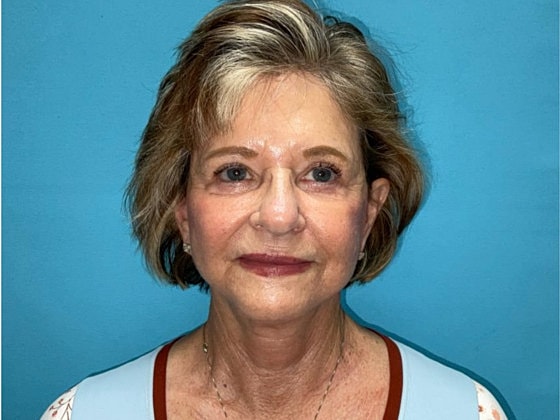 Facelift Before & After