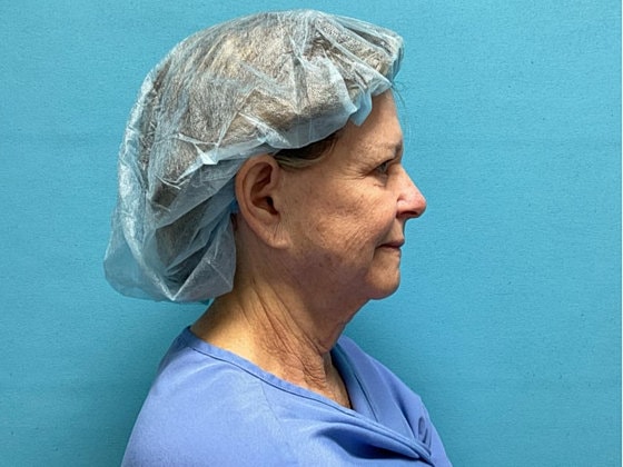 Facelift Before & After