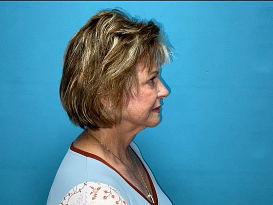 Facelift Before & After