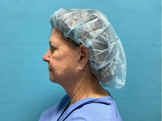 Facelift Before & After