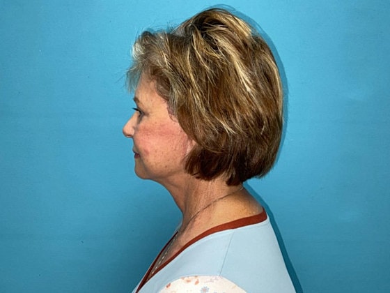 Facelift Before & After