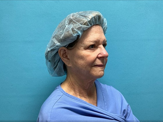 Facelift Before & After