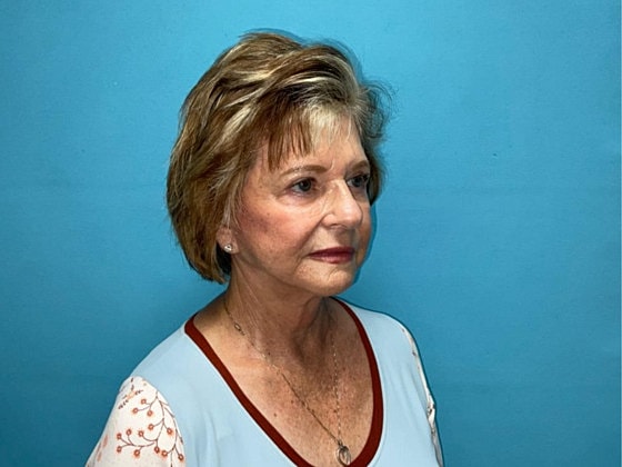 Facelift Before & After