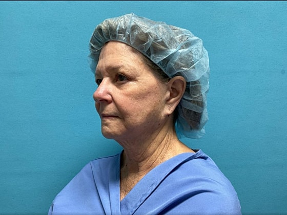 Facelift Before & After