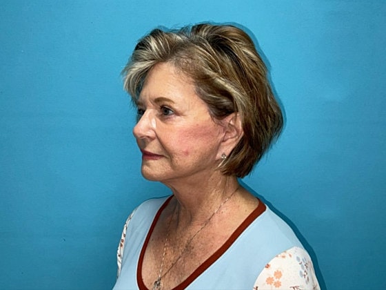 Facelift Before & After