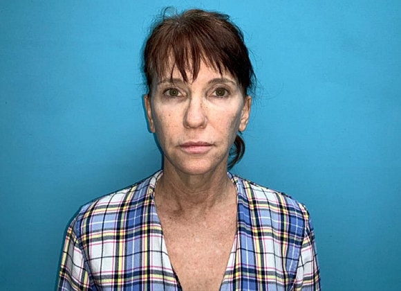 Facelift Before & After